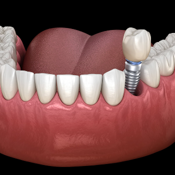 Dental Implants in Wakad Pune – CDIC Smiles | Cdic Smiles Dental Clinic, Wakad | Wakad Pune, Maharashtra 411047, India