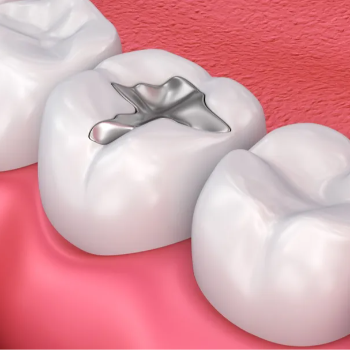 Dental fillings for cavities | Prime Dental Care | FF101 Vandematram Fabula ,Malabar County Road, Behind Nirma University, Chharodi, Ahmedabad 382481