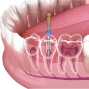 Root canal treatment | Sai Dental And Implant Center | Anurag, Plot No.7, Near, Cummins College Rd, Anand Colony, Suvarn Colony, Hingne Budrukh, Karve Nagar