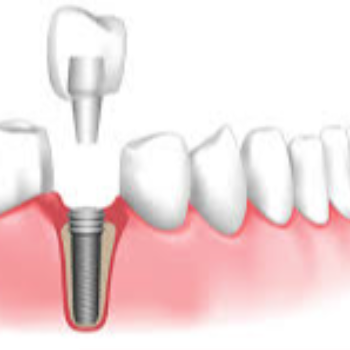 Dental implants | Sai Dental And Implant Center | Anurag, Plot No.7, Near, Cummins College Rd, Anand Colony, Suvarn Colony, Hingne Budrukh, Karve Nagar