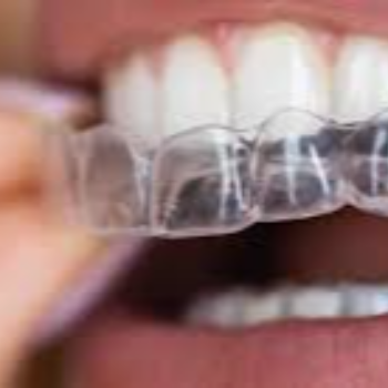 Clear Aligners | Sai Dental And Implant Center | Anurag, Plot No.7, Near, Cummins College Rd, Anand Colony, Suvarn Colony, Hingne Budrukh, Karve Nagar