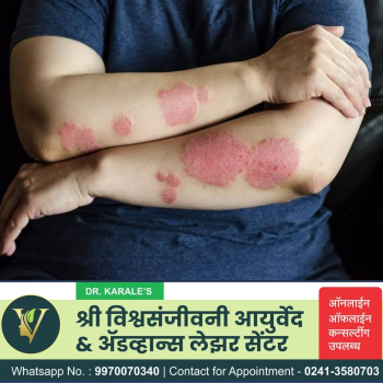 Effective Psoriasis Treatment | Shri Vishwasanjeevani Ayurved And Advance Laser Center | Flat No 204, Aaradhya Avenue, Pipeline Rd, Near Ekvira Chowk, Savedi, Ahmednagar, Maharashtra 414003, India
