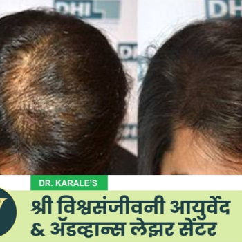केस पातळ होणे - Hair Thinning | Shri Vishwasanjeevani Ayurved And Advance Laser Center | Flat No 204, Aaradhya Avenue, Pipeline Rd, Near Ekvira Chowk, Savedi, Ahmednagar, Maharashtra 414003, India