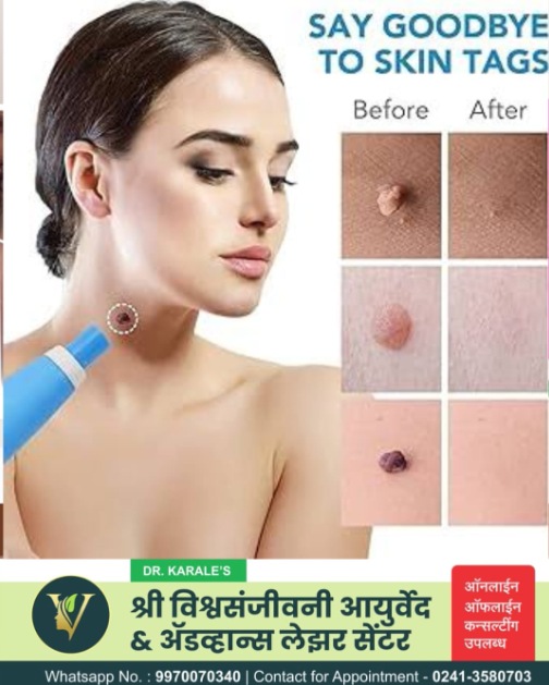 मस व वेदनारहीत चामखिळ  -  Painless Skin Tags and wart Removal | Shri Vishwasanjeevani Ayurved And Advance Laser Center | Flat No 204, Aaradhya Avenue, Pipeline Rd, Near Ekvira Chowk, Savedi, Ahmednagar, Maharashtra 414003, India