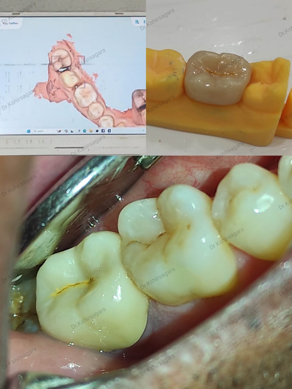 3-M Lava Monolith (full ceramic cap) for Back Teeth | Dr. Kshirsagar's Multispeciality Dental Care | Office No, 13,first Floor, Nirmaan Square, Kamthe Patil Nagar, Yeolewadi, Pune, Yewalewadi, Maharashtra 411048, India