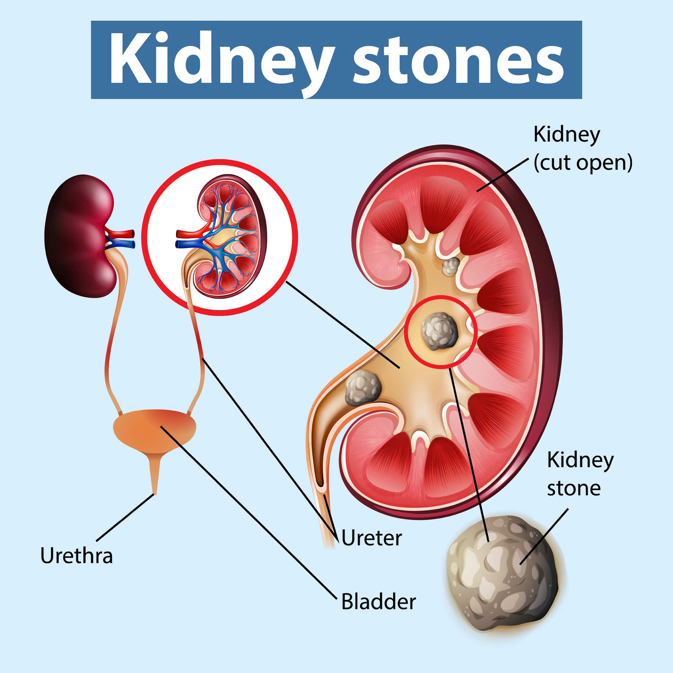 Kidney Stones (मूतखडे) Dr SAURABH'S HOMOEOPATHIC CLINIC Pune, Maharashtra 411046, India