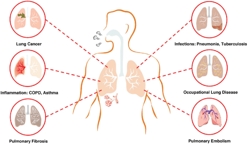 Respiratory Diseases (फुफ्फुसांचे विकार) Dr SAURABH'S HOMOEOPATHIC CLINIC Pune, Maharashtra 411046, India