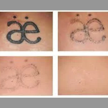 Tattoo removal | D'souza Tattoo Studio | Shop No. 06, Shree Sant Tukaram Complex, Opposite Apple Salon, Above Sujata Mastani, Near D'mart, Hinjewadi Phase 1, Maharashtra 411057, India