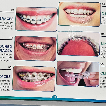 Types of Dental braces | Smile Care Dental Clinic | Smile Care Dental Clinic 32 Varuchi Marg Near Madhav Nagar Police Station, Ujjain, Madhya Pradesh