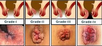 Plies | Armonia Homoeopathic Clinic | Shrenik Garden, Shahu Colony, Lane No. 1, Karve Nagar, Pune, Maharashtra 411058, India