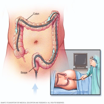 Colonoscopy | Prime Hospital | 347/7,  Opposite Gangapuri Road, Sanoli Road, Panipat, Haryana, 132103