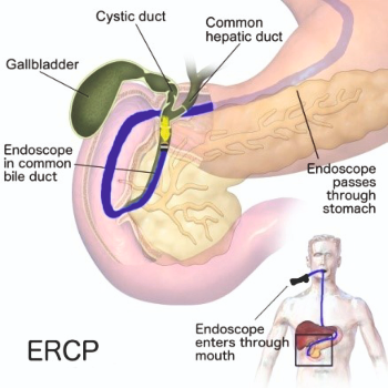 ERCP | Prime Hospital | 347/7,  Opposite Gangapuri Road, Sanoli Road, Panipat, Haryana, 132103