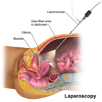 Laparoscopy surgery | Argade Clinic | Office3/4, Keystone Business Hub, Opp. Bhelake Nagar, Near Yashwantrao Chavan Natyagruha, Ganesh Nagar Co-Operative Housing Society, Londhe Wada, Chaitanya Nagar, Kothrud, Pune, Maharashtra 411038, India
