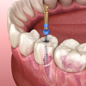 Root Canal | Shree Dental- Dr. Vittal Nagrgoje | Pimpri-Chinchwad, Maharashtra 411027, India