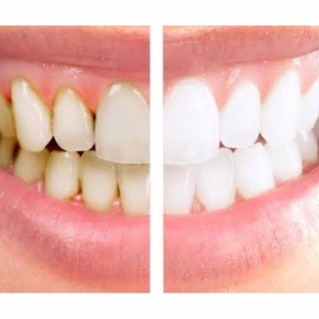 Scaling & Polishing | Shree Dental- Dr. Vittal Nagrgoje | Pimpri-Chinchwad, Maharashtra 411027, India