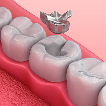 Dental Filings Care 32 Dental Clinic And Implant Center Adarsh Complex, Sahakari Jin Rd, Nautan Vihar Society,  Gadhoda, Gujarat 383001, India