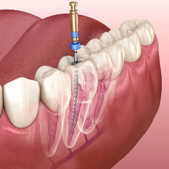 Root Canal Treatment Care 32 Dental Clinic And Implant Center Adarsh Complex, Sahakari Jin Rd, Nautan Vihar Society,  Gadhoda, Gujarat 383001, India