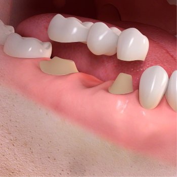 Crown and Bridges Care 32 Dental Clinic And Implant Center Adarsh Complex, Sahakari Jin Rd, Nautan Vihar Society,  Gadhoda, Gujarat 383001, India
