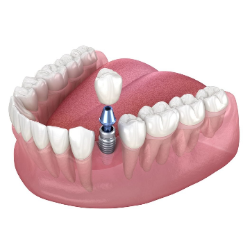 Dental Implants Care 32 Dental Clinic And Implant Center Adarsh Complex, Sahakari Jin Rd, Nautan Vihar Society,  Gadhoda, Gujarat 383001, India