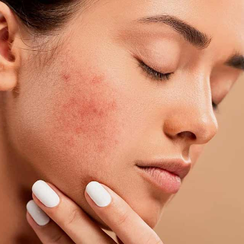 Acne Treatment | Wisteria Beauty Salon & Spa | Shop No. 8A, Ratnmala Complex, Near Tanaji Chauk, Stand, Kothrud, Pune, Maharashtra 411038, India