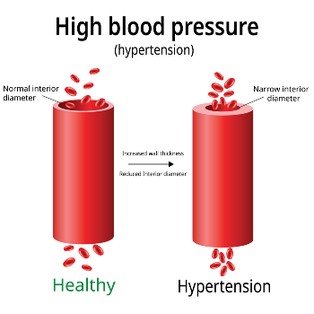 High Blood Pressure Treatment | Radhakrishna Hospital | Mumbai - Agra Rd, Near IDBI Bank, Pimpalgaon Baswant, Maharashtra 422209, India