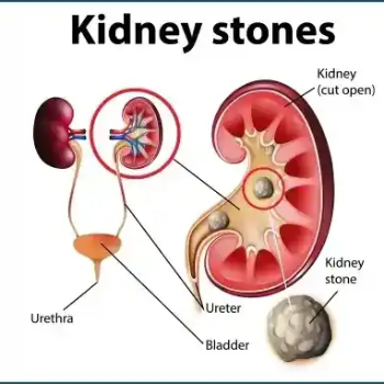 Treatment of Urinary Tract diseases, Kidney Stones | Radhakrishna Hospital | Mumbai - Agra Rd, Near IDBI Bank, Pimpalgaon Baswant, Maharashtra 422209, India