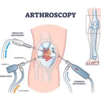 Laparoscopic Knee Surgery | Radhakrishna Hospital | Mumbai - Agra Rd, Near IDBI Bank, Pimpalgaon Baswant, Maharashtra 422209, India
