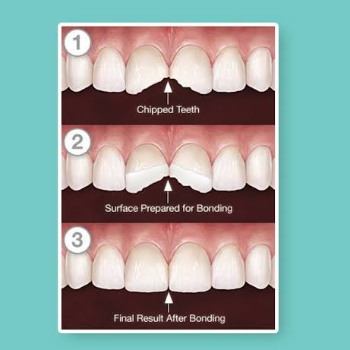 Dental Fillings | ASHWIN DENTAL CLINIC | King's Square Building, J-11, New DP Rd, Near Medipoint Hospital In Between Bank Of Baroda & Indian Bank, Aundh, Pune, 411007