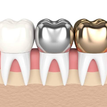 Dental Crowns | ASHWIN DENTAL CLINIC | King's Square Building, J-11, New DP Rd, Near Medipoint Hospital In Between Bank Of Baroda & Indian Bank, Aundh, Pune, 411007