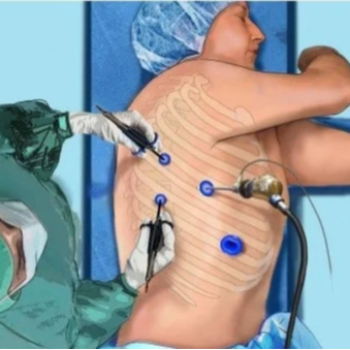 Thoracoscopy services | Chest Clinic, Pune | 5th Floor, Nandan Pride, A Wing, Karve Putala Chowk, Mayur Colony, Kothrud, Pune, Maharashtra 411038, India