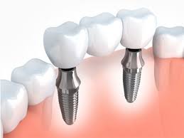 Implants | Tooth & Co | Ground Floor Jayanand Apartment, Opp Yatri Hotel, Paud Phata, Karve Rd, Kuldeep Cooperative Housing Society, Kothrud, Pune, Maharashtra 411038, India