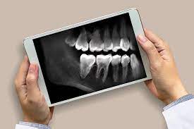 Dental X- ray | BRACES And Faces | 38 Brajeshwari Annex Near Ados Pados Apartment Bangali Squre Indore