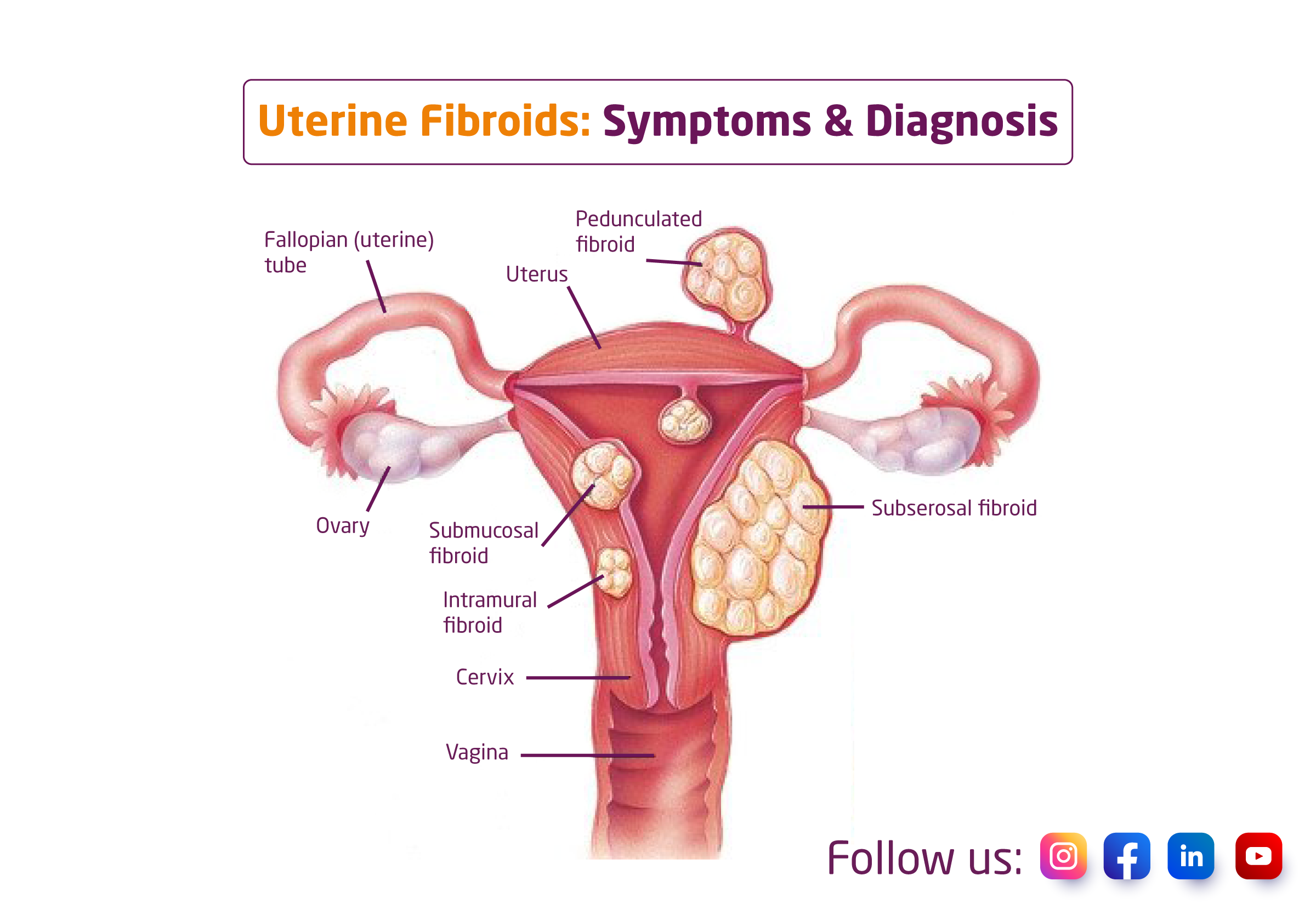 PCOD & Uterine Fibroid Treatment with Homeopathy in Pune | Dr. Shweta's Homoeopathic Healthcare Clinic | Dhanori, Shop No.14, Pride Aashiyana Shopping Complex,Bharat Mata Road, Near Nyati Evita, Lohegaon, Pune