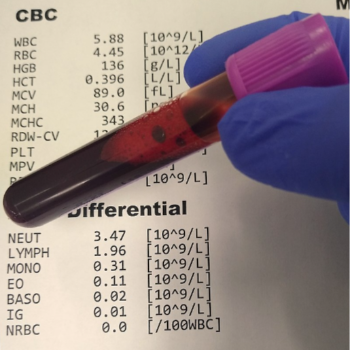 CBC Blood Test in Hadapsar Pune | Golwilkar Metropolis | No 796/189 B, Gr Flr, Construction House, Bhandarkar Road, Pune, 411004