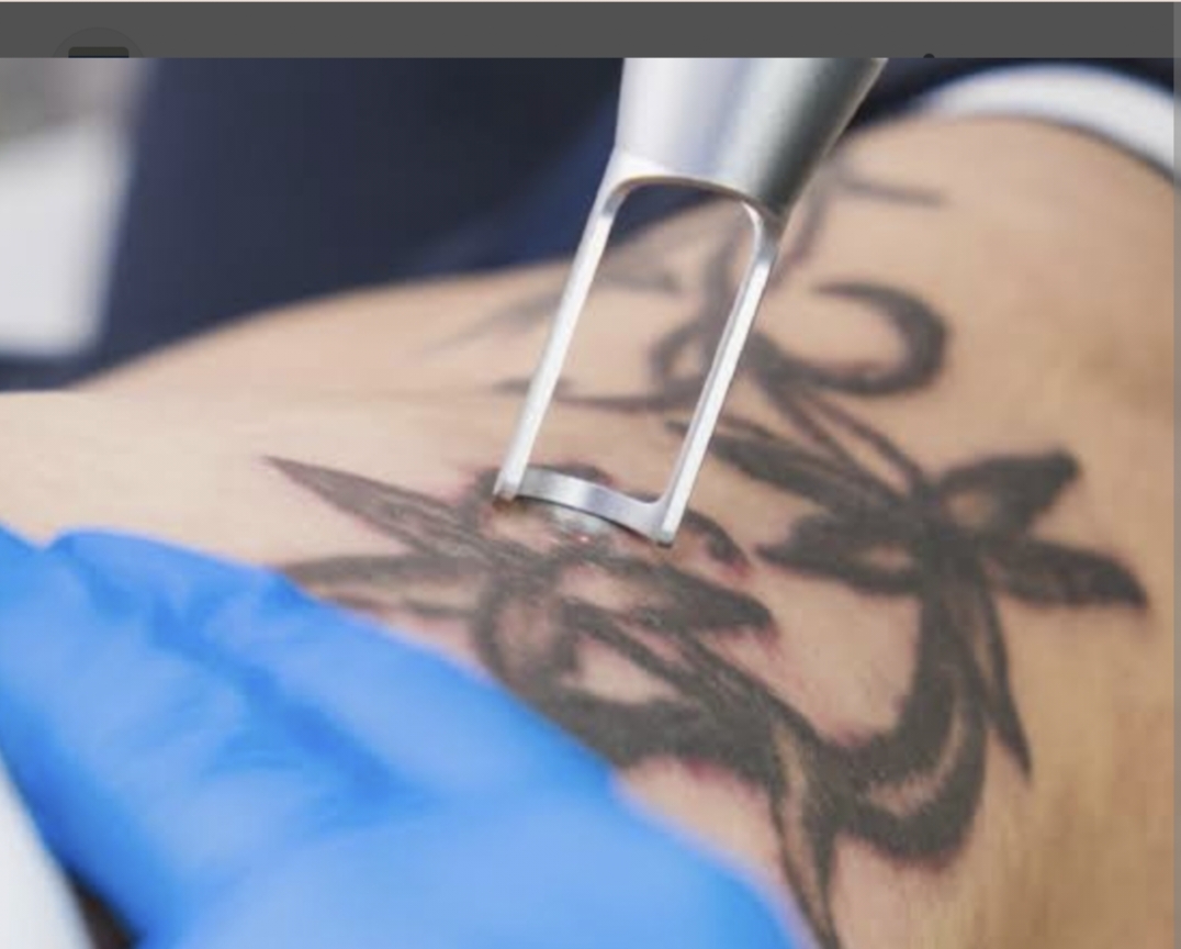 Tattoo Removal | BRACES And Faces | 38 Brajeshwari Annex Near Ados Pados Apartment Bangali Squre Indore