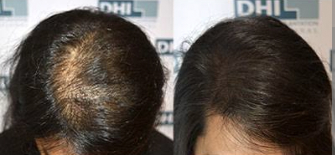 Hair loss treatment | BRACES And Faces | 38 Brajeshwari Annex Near Ados Pados Apartment Bangali Squre Indore