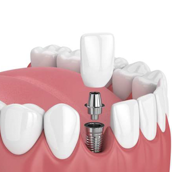 Dental Implanting | Dental Clinic | G19geribaa Dental Care Mahalaxmi Complex Bhatar Char Rasta